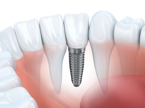 Implantater hos Elvebredden Tannlegesenter